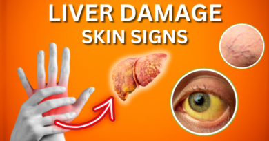 Skin Signs of Liver Disease